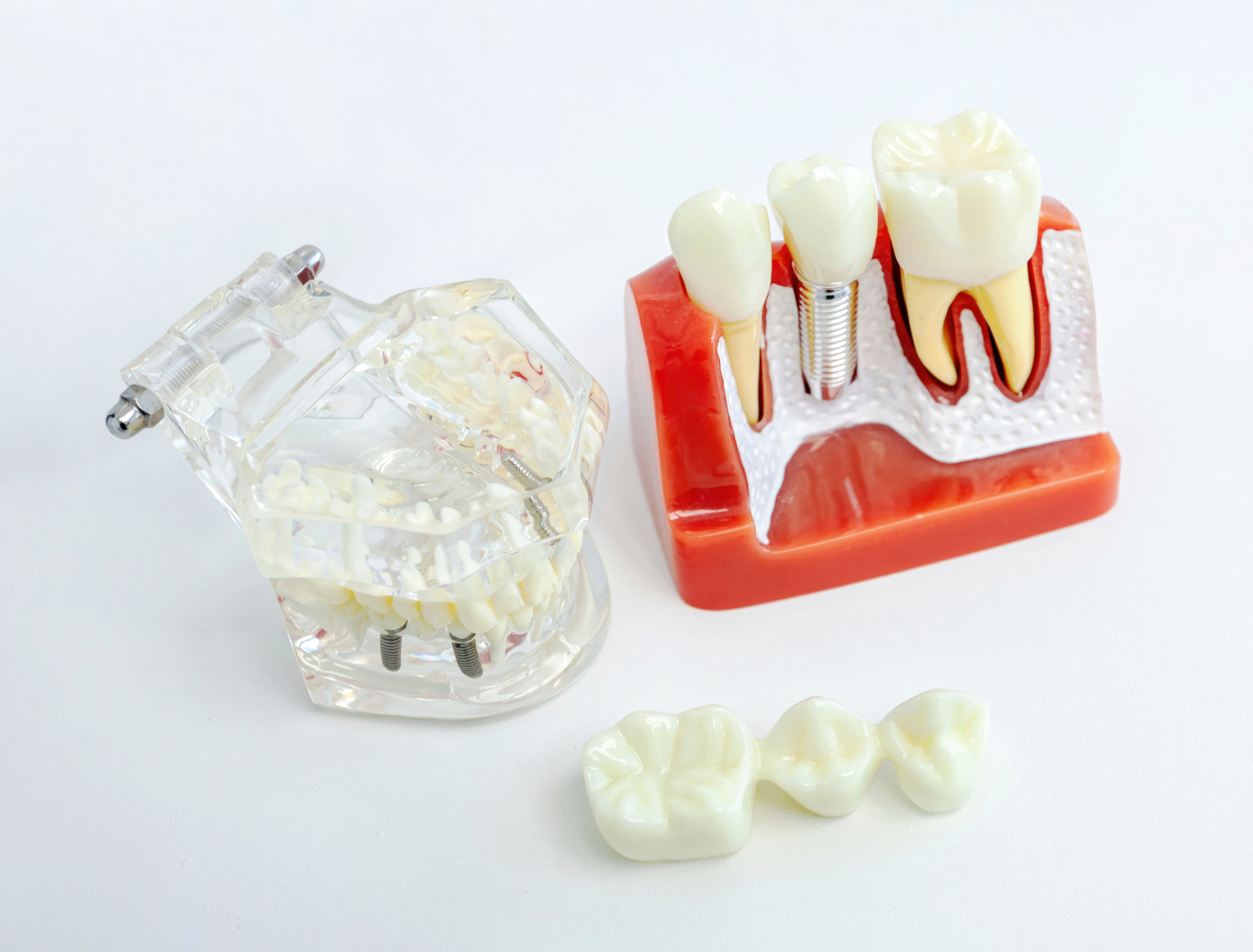 임플란트 재료 이미지