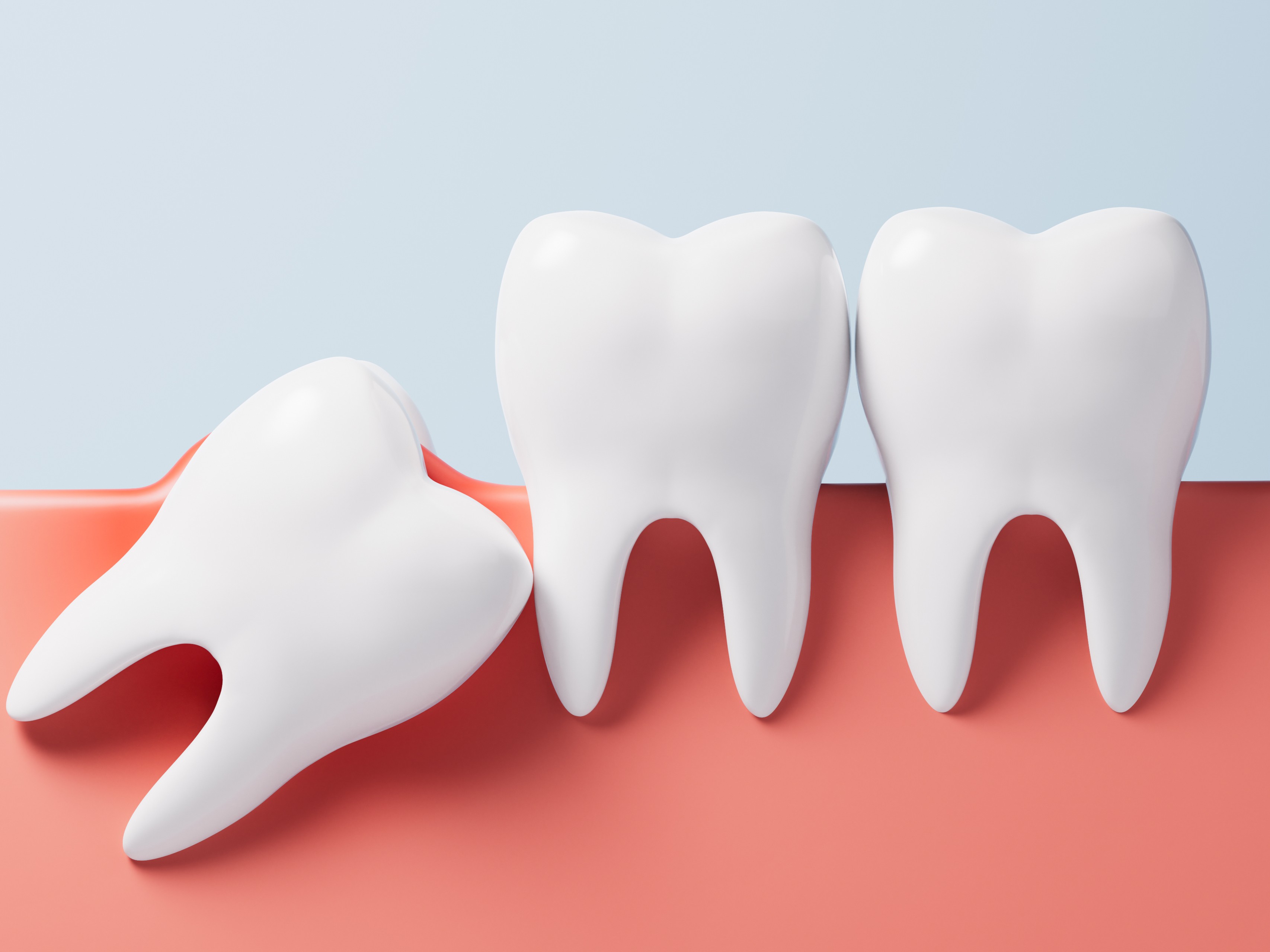 사랑니 발치 이미지