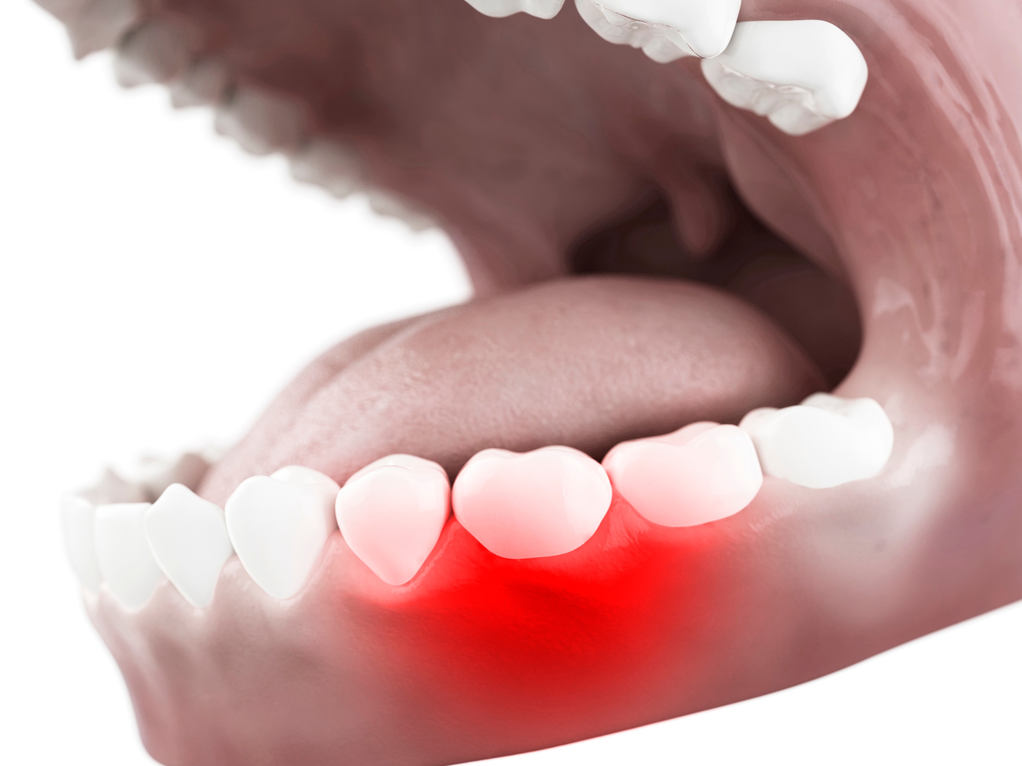 잇몸치료 / 잇몸재건 이미지